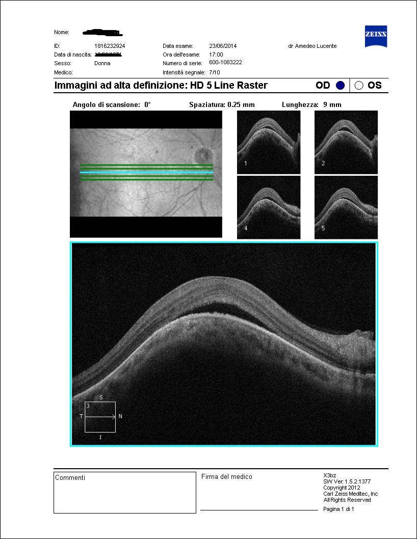 Dome-Shaped Macula con sierosa centrale cronica bilaterale